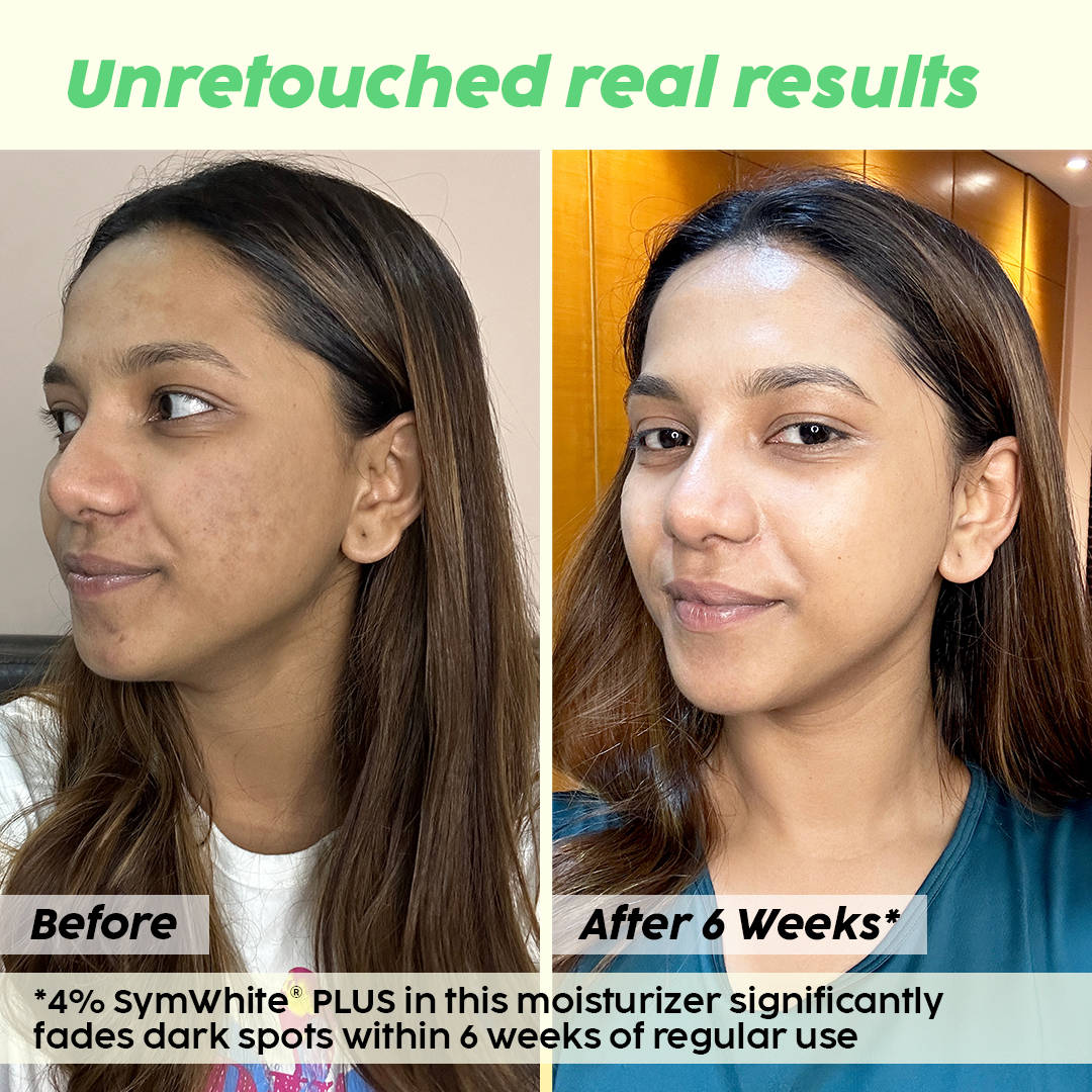 2% Alpha Arbutin Depigmentation Combo For Dark Spot Removal With Serum & Moisturizer | PL1 - view 3