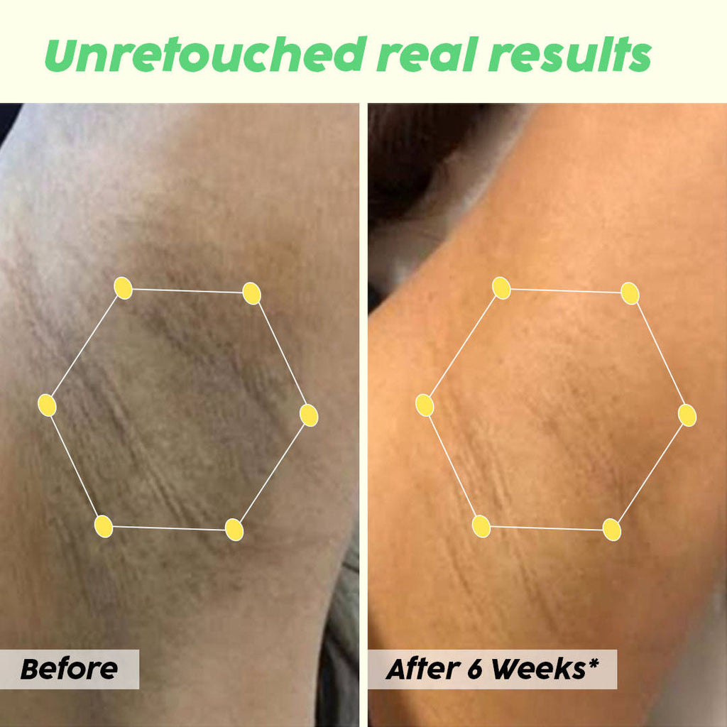 Underarm Depigmentation Serum Spray & 2% Alpha Arbutin Face Serum Combo For Hyperpigmentation | PL1 - view 3