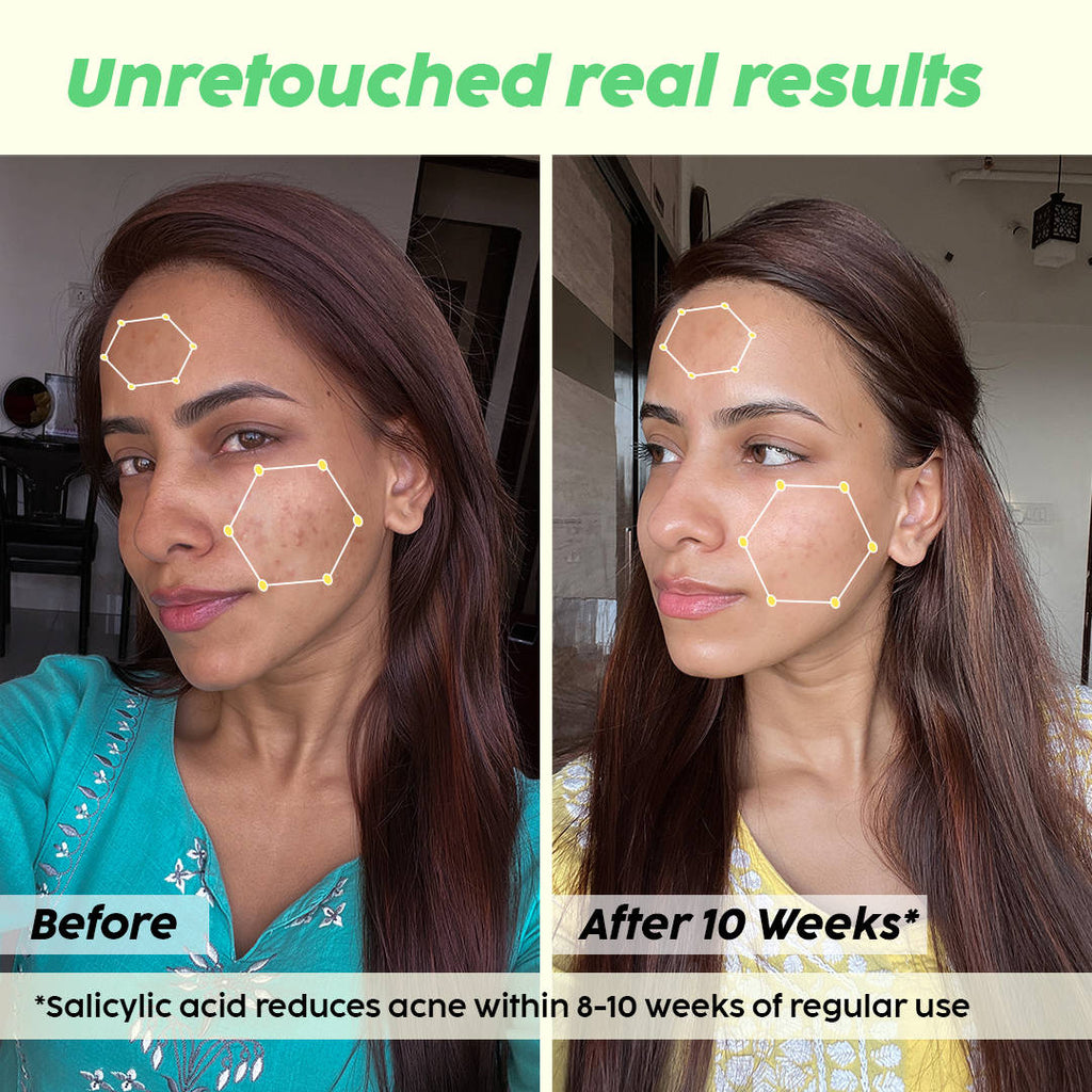 2% Acne Buster Moisturizer & Salicylic Acid Sunscreen SPF50+ PA+++, Reduce Acne, Pimple Marks | PL1 - view 4